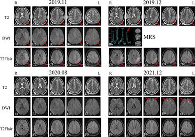 Case report: Two siblings with neuronal intranuclear inclusion disease exhibiting distinct clinicoradiological findings